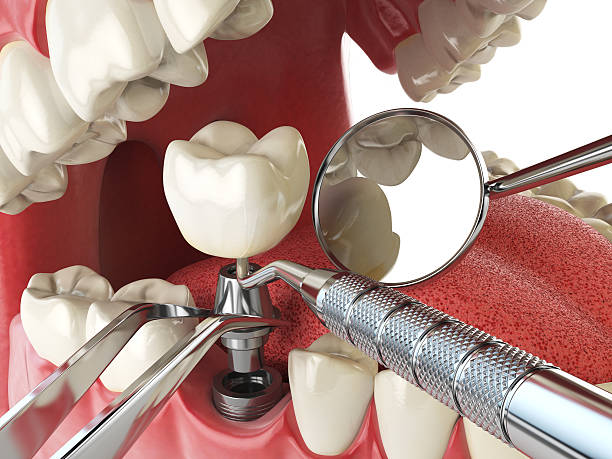 Best Emergency Root Canal Treatment in St Albans, VT